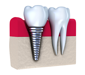 Dental Implants | Dentist in Ann Arbor, MI | Bonnie P. Patel, DDS