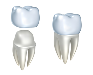 Dental Crowns | Dentist in Ann Arbor, MI | Bonnie P. Patel, DDS